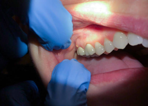 Best Emergency Dental Extractions in Wlowbrook, IL